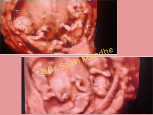 Multiple pregnancies